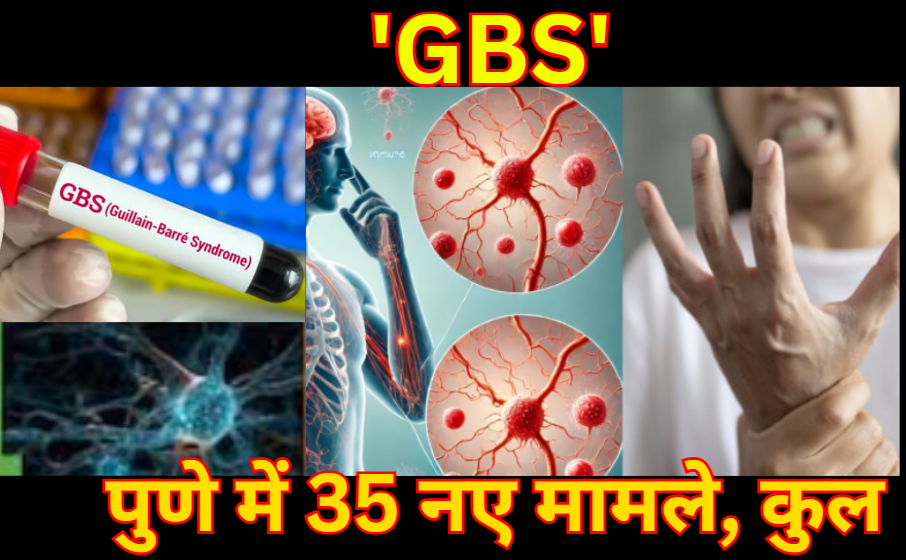 GBS